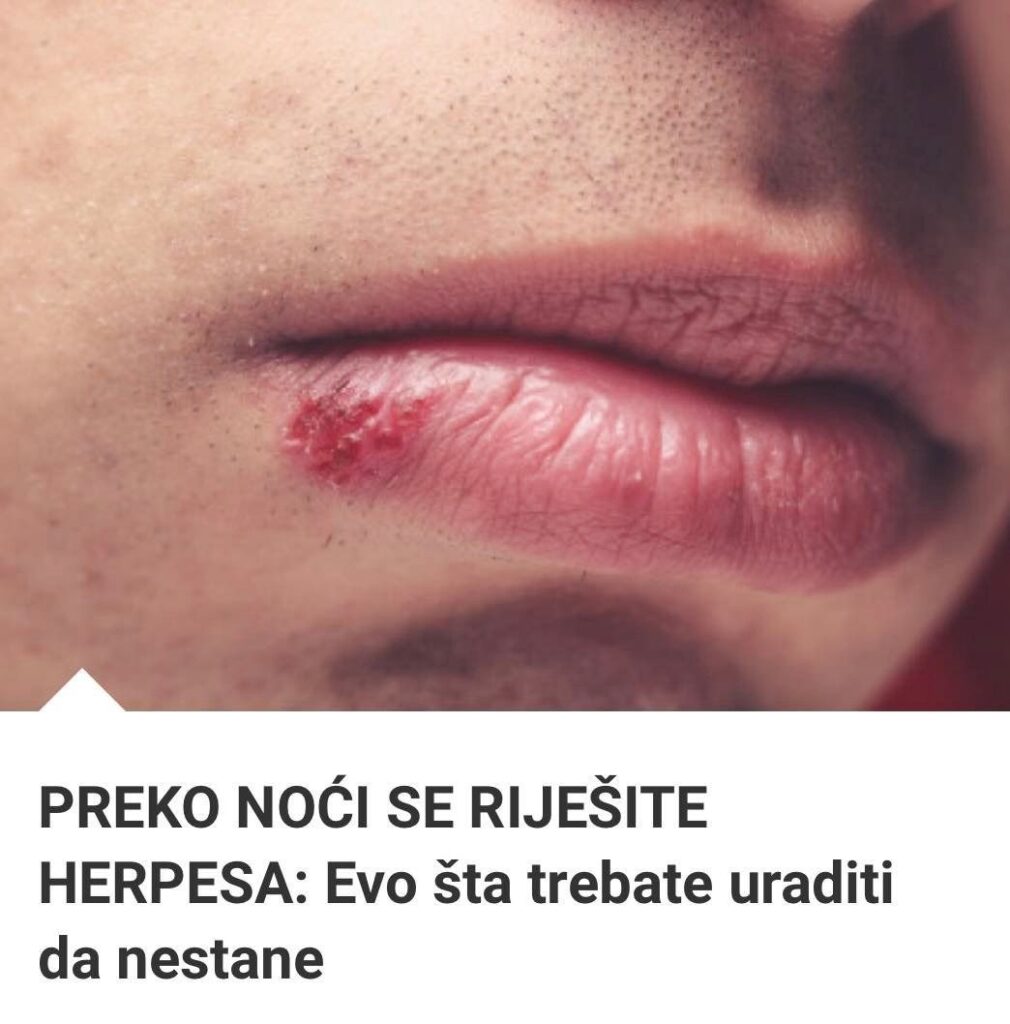 Preko No I Se Rije Ite Herpesa Evo Ta Trebate Balkanski Magazin